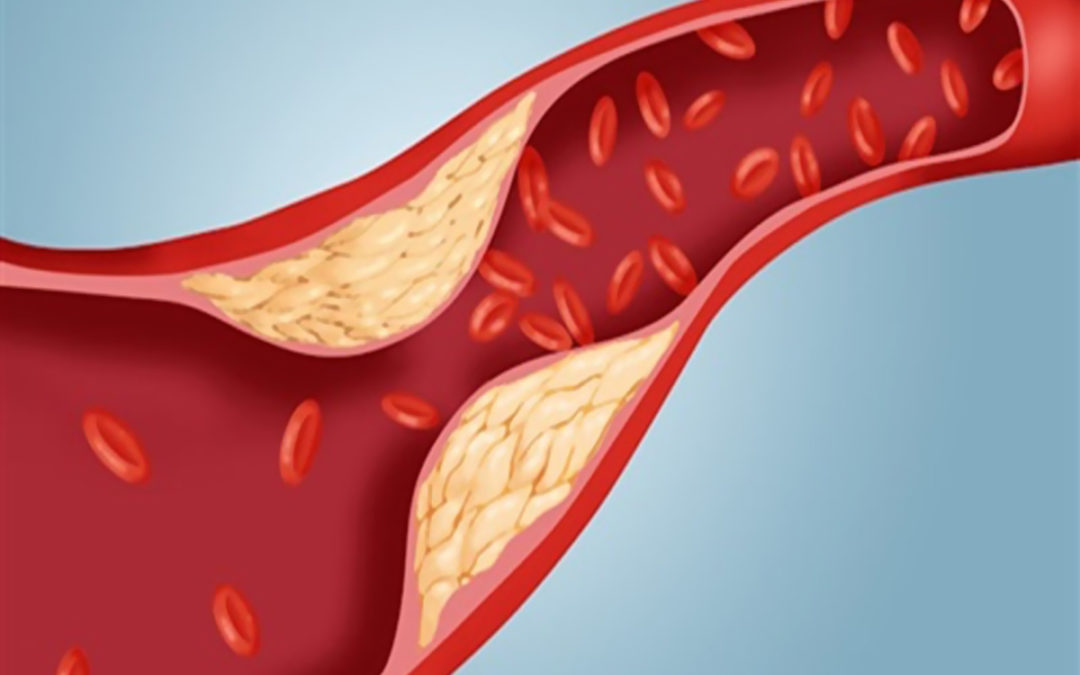 نصائح للحد من ارتفاع نسبة الكوليسترول في الدم